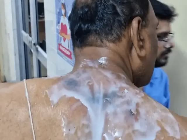 Sonbhadra News: रावण दहन के दौरान पुतले से निकली चिंगारी भीड़ में गिरी, छह लोग हुए घायल, हिंडाल्को अस्पताल में भर्ती.