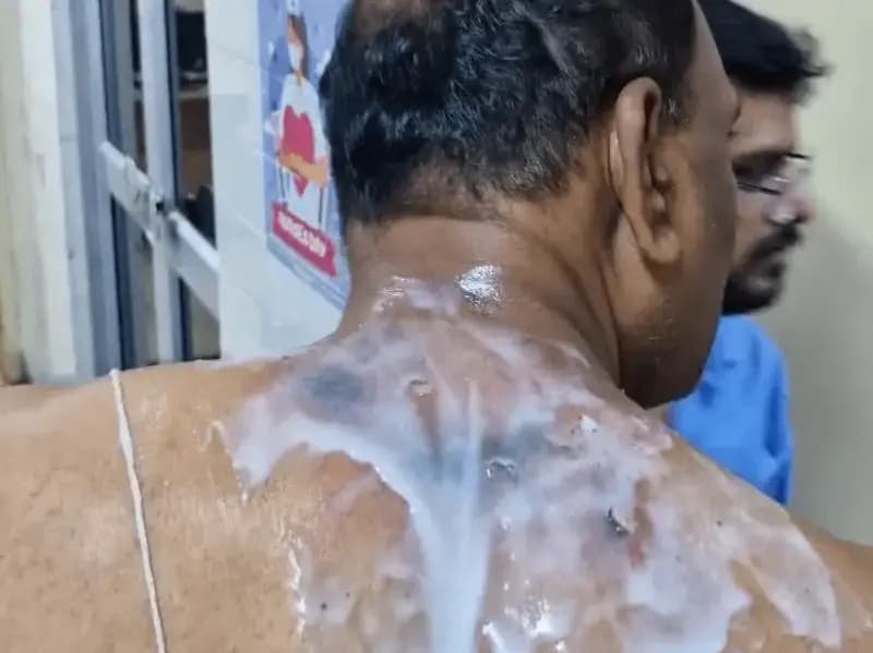 Sonbhadra News: रावण दहन के दौरान पुतले से निकली चिंगारी भीड़ में गिरी, छह लोग हुए घायल, हिंडाल्को अस्पताल में भर्ती.